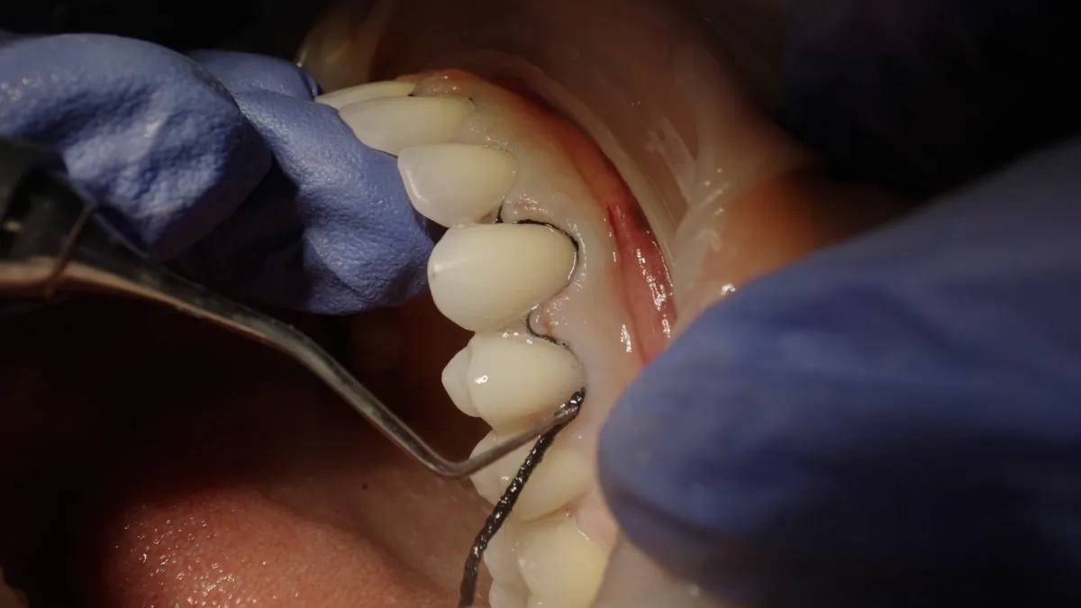 Close-up of gloved hands and dental instruments working on a patient's front teeth